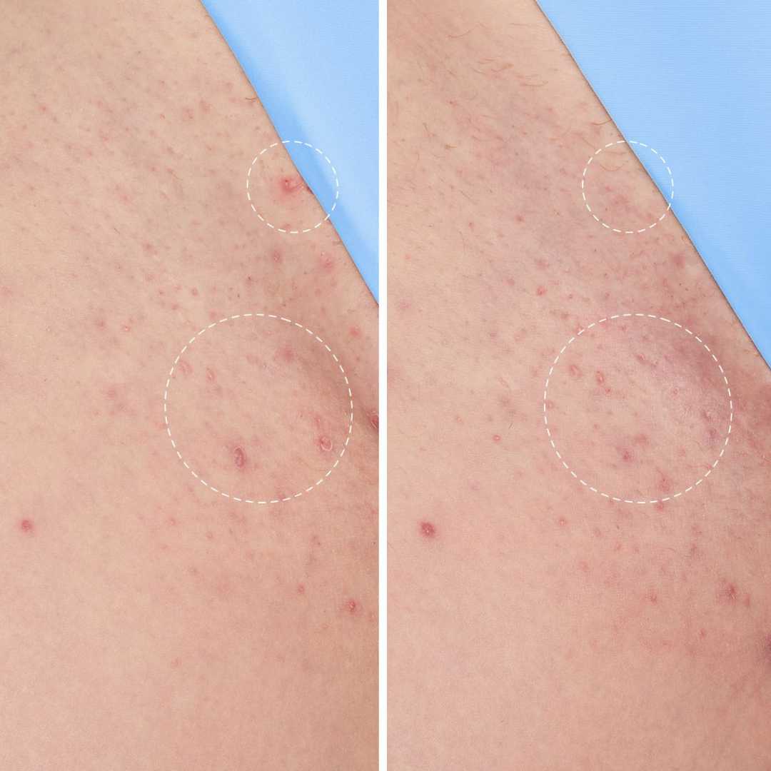 Peach Slices® Solución suavizante para el tratamiento de vellos encarnados